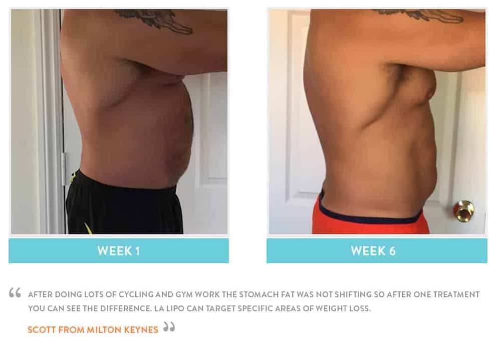 Before & After Stomach Fat Welwyn Garden City
