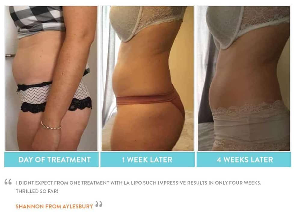 before, Cryolipolysis Welwyn Garden City