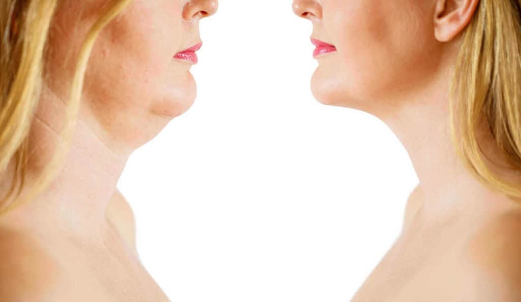 Double Chin treatment Welwyn Garden City before and after results