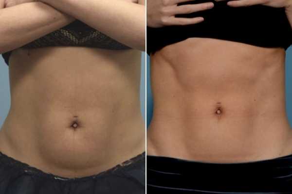 body sculpting FAQs Welwyn Garden City