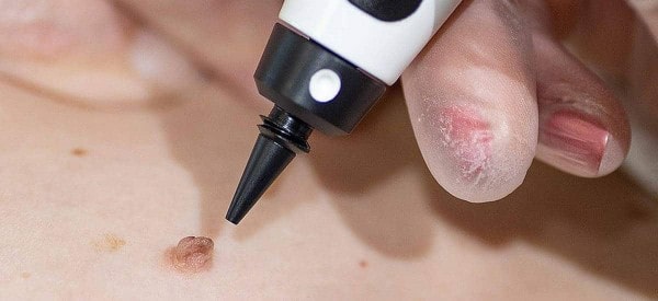 After Skin Tag Removal Welwyn Garden City