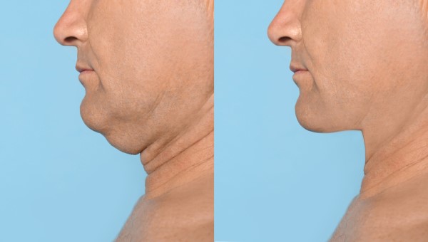 Which Non-Surgical Treatments Work Best for Jowls and Loose Skin Welwyn Garden City?