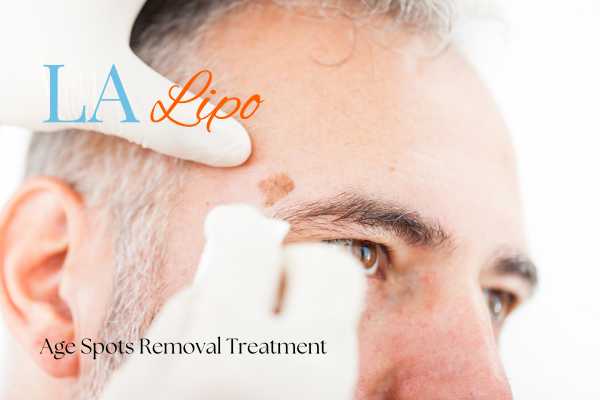 What Are the Most Effective Treatments for Age Spots Welwyn Garden City?