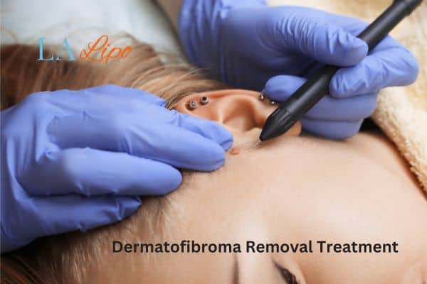 Dermatofibroma Removal Treatment Welwyn Garden City