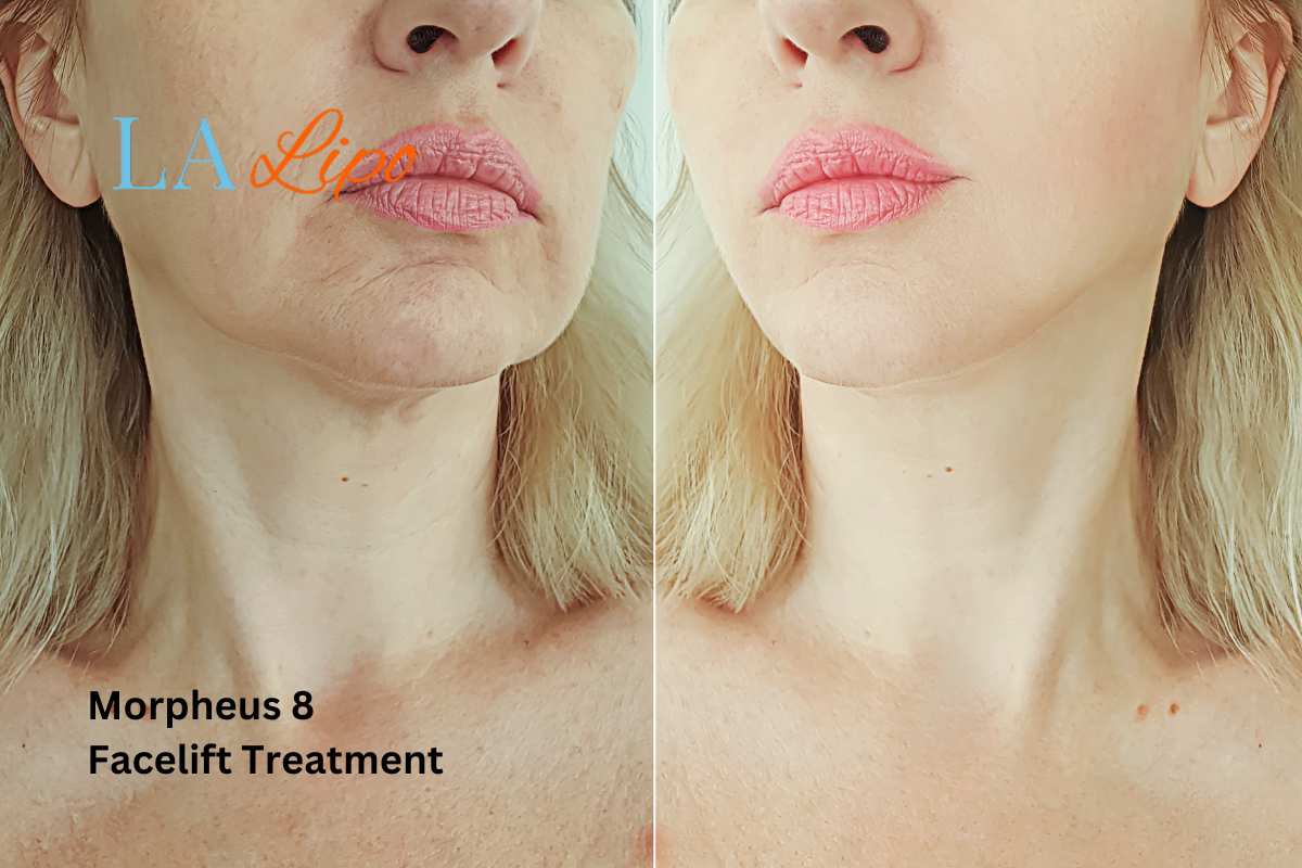 Turn back time with Morpheus8 Treatment Welwyn Garden City