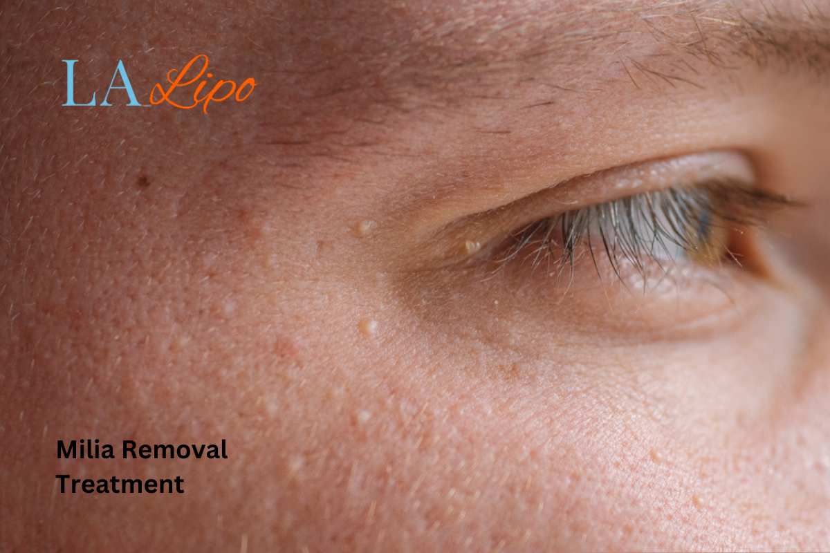 Cryopen Milia Removal: Is It the Easiest and Safest Option Welwyn Garden City?