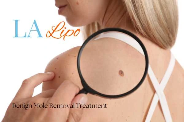 Why getting moles removed Welwyn Garden City can boost your confidence!