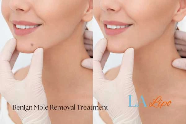 woman's before and after mole removal Welwyn Garden City results