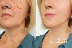 hi-fu for wrinkles Welwyn Garden City before and after results