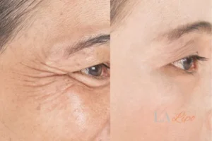 Before and after results of woman - HI-fu wrinkles reduction treatment Welwyn Garden City