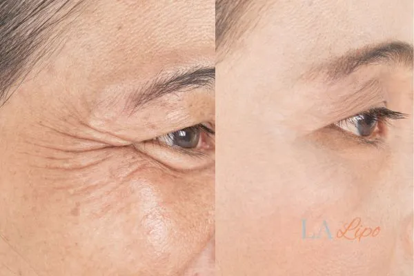 Before and after results of woman - HI-fu wrinkles reduction treatment Welwyn Garden City
