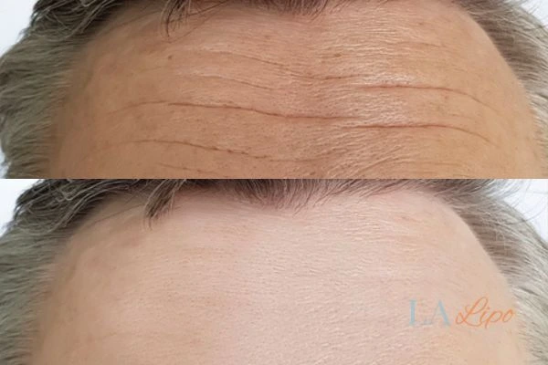 results of HIFU Welwyn Garden City on mans forehead to help reduce lines and wrinkles