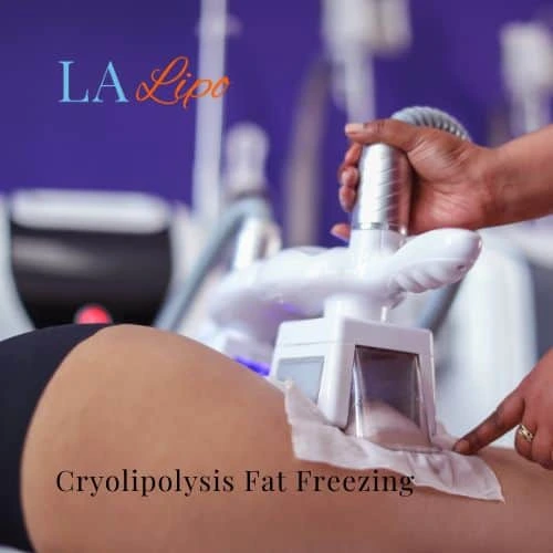 fat freezing - Cryolipolysis Welwyn Garden City