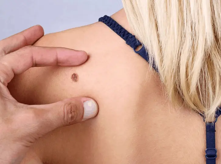 woman having mole removal Welwyn Garden City consultation before treatment.
