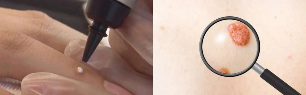 Person getting moles removed with cryopen Welwyn Garden City