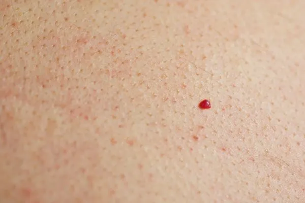 close up of a cherry angioma Welwyn Garden City