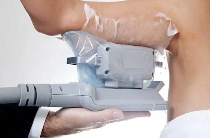 Picture of fat freezing Welwyn Garden City on the upper arms.