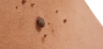 image of a skin tag Welwyn Garden City