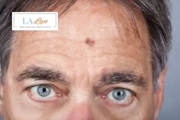 Solar Lentigo Removal Welwyn Garden City image of man with mark on his forehead