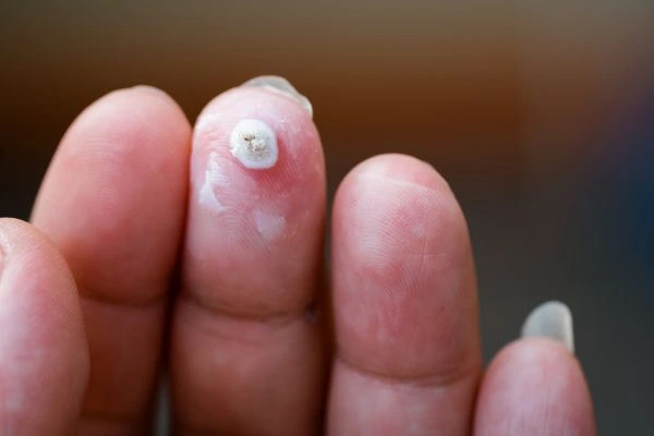 wart on person finger - cryotherapy to treat from LA LIPO Welwyn Garden City