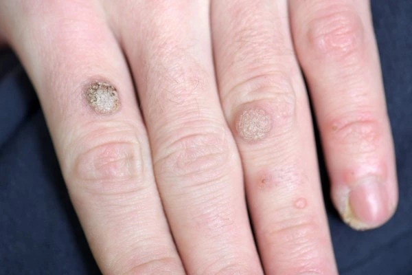 photo of warts on person hand - see wart removal Welwyn Garden City from LA LIPO