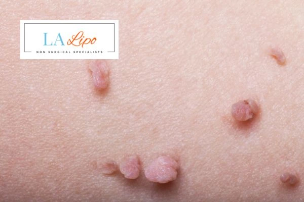 Does cryopen skin tag removal Welwyn Garden City hurt? Find out now call our team today!