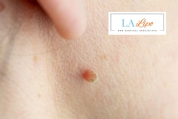 Book skin tag removal Welwyn Garden City today speak to our team now!
