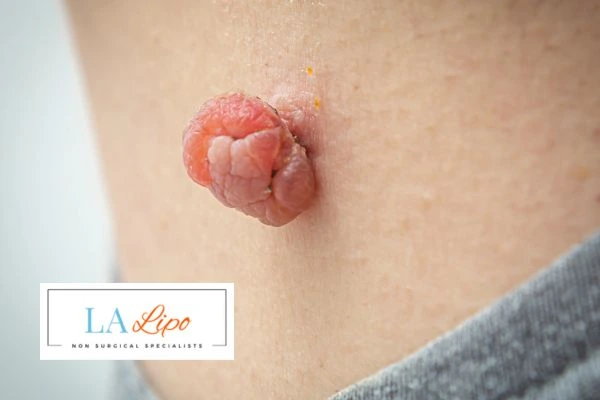 Interested in skin tag removal Welwyn Garden City? Concerned about the pain? Find out more today!