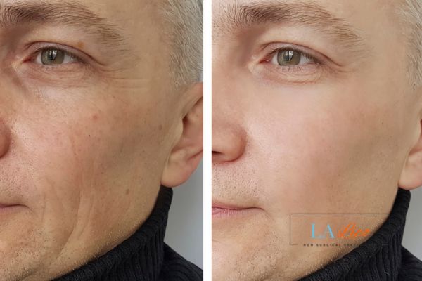 See the amazing results of Morpheus8 Treatment Welwyn Garden City!