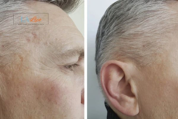 Mens Before & After Morpheus 8 Results Welwyn Garden City