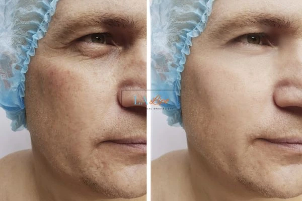 Before and after Morpheus 8 Results Welwyn Garden City