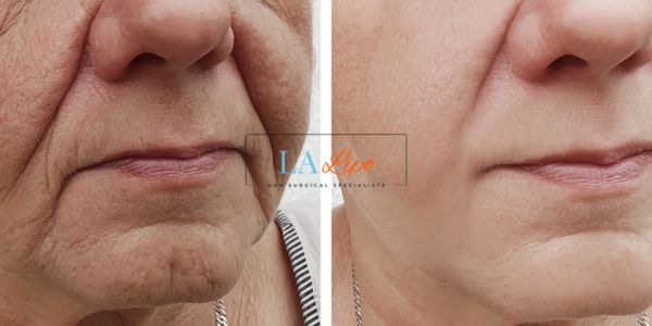 Older lady deeper wrinkle reduction - LA LIPO Morpheus 8 Results Welwyn Garden City