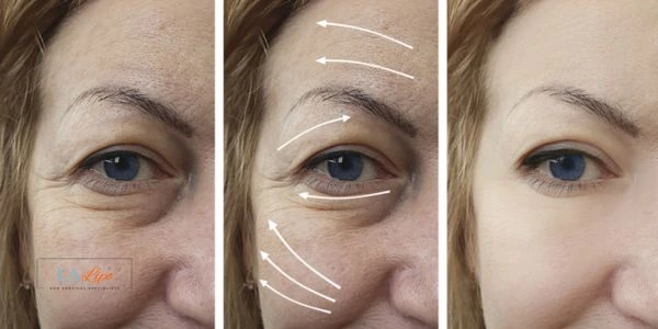 Amazing eye lift Morpheus 8 results Welwyn Garden City