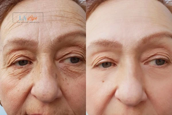 The powerful benefits of Morpheus8 Treatment Welwyn Garden City - Call Our team today!