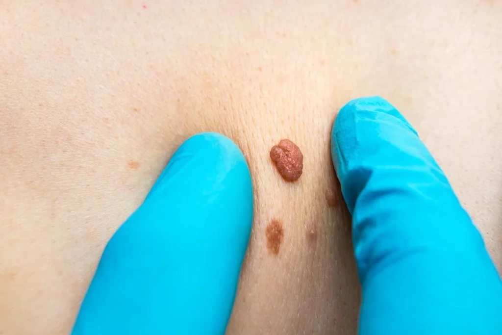 LA LIPO Cryopen Lesion Removal Prices Welwyn Garden City