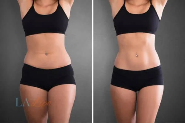 before and after results of non-surgical treatment to help a woman's body image and mental health Welwyn Garden City