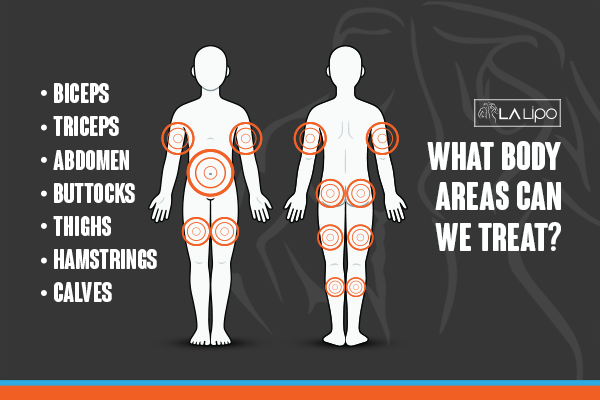 Diagram to show areas you can have LA-EMS Body Sculpting Treatment Welwyn Garden City