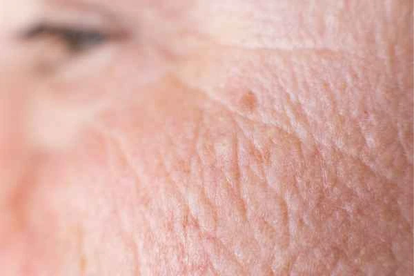 close up picture of a woman's face showing an age spot Welwyn Garden City