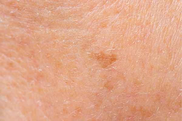 close up picture of age spots Welwyn Garden City