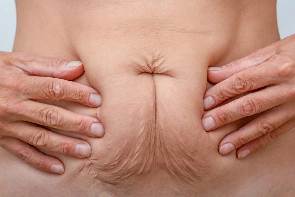 Image of a woman's stomach with loose skin - example of skin tightening Welwyn Garden City options