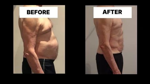 What Symptoms Can Diastasis Recti Cause in Men? Weak Core, Back Pain and Poor Posture Welwyn Garden City